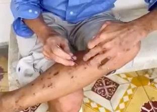 TP.HCM: Người đàn ông bị hoang tưởng nhiễm ký sinh trùng