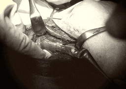 Phát hiện vi khuẩn kháng nhiều loại kháng sinh trong ổ áp xe giáp