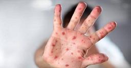 Bệnh nhi tay chân miệng tăng vọt, 4 ca tử vong, Bộ Y tế có công văn khẩn