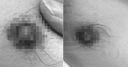 TP.HCM: Nam thanh niên mắc giang mai vú, thế giới chỉ ghi nhận 13 ca