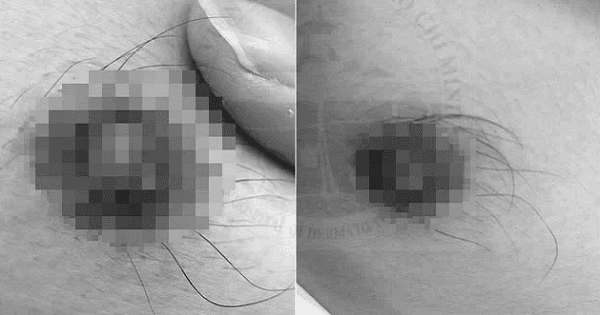 TP.HCM: Nam thanh niên mắc giang mai vú, thế giới chỉ ghi nhận 13 ca