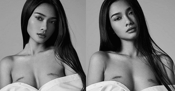 Hoa hậu Myanmar - đối thủ mà Khánh Vân giúp đỡ - có hai vết sẹo lớn ở ngực