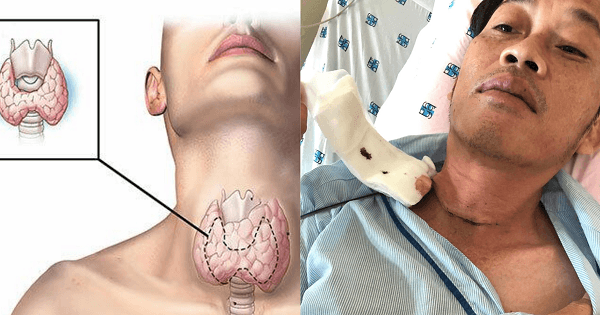 Bệnh ung thư tuyến giáp mà Hoài Linh mắc phải là gì, có nguy hiểm không?