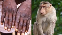 WHO xác nhận 92 ca bệnh đậu mùa khỉ trên thế giới, khả năng bùng phát cao