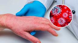 Châu Âu ghi nhận ca tử vong đậu mùa khỉ đầu tiên ở Tây Ban Nha