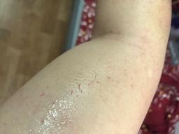 Việt Nam ghi nhận người đàn ông đổ "mồ hôi máu" đầu tiên