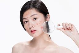 Gợi ý 5 viên uống trị mụn lành tính giúp làn da mịn màng
