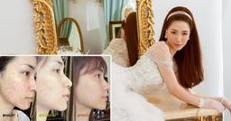 Can đảm như Hoà Minzy: Khoe làn da trị mụn thịt chi chít vết sẹo