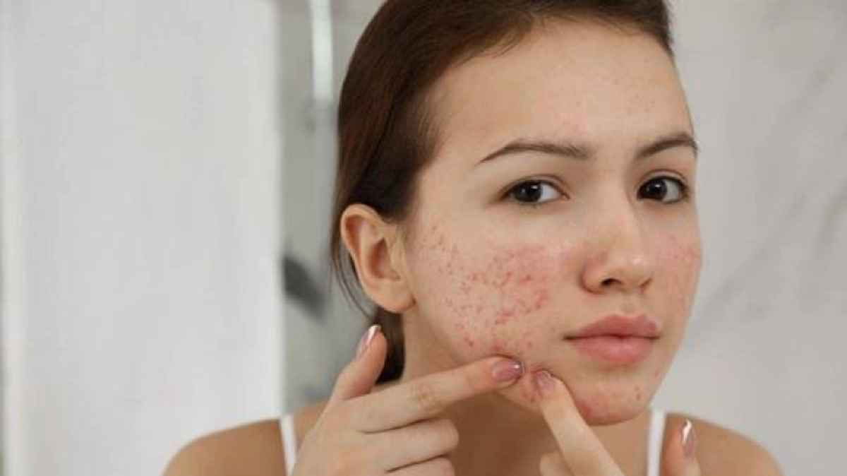 Mụn tuổi dậy thì có hết không?